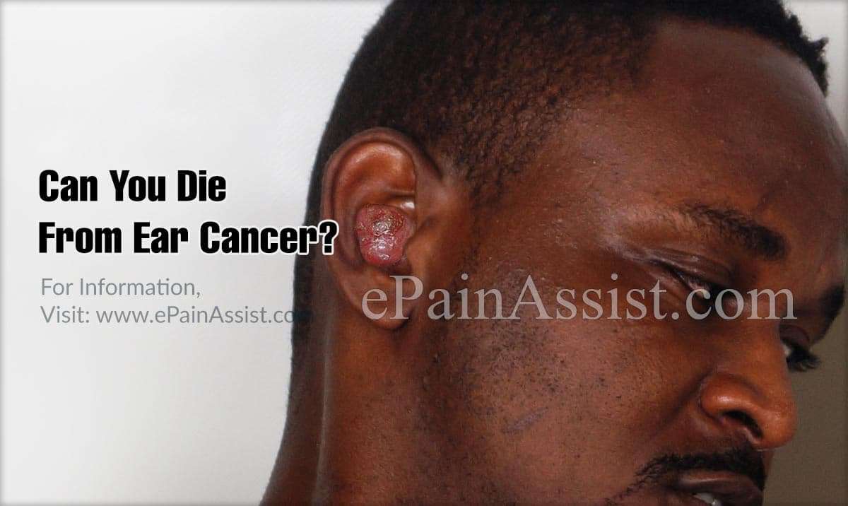 Can You Die From Ear Cancer?