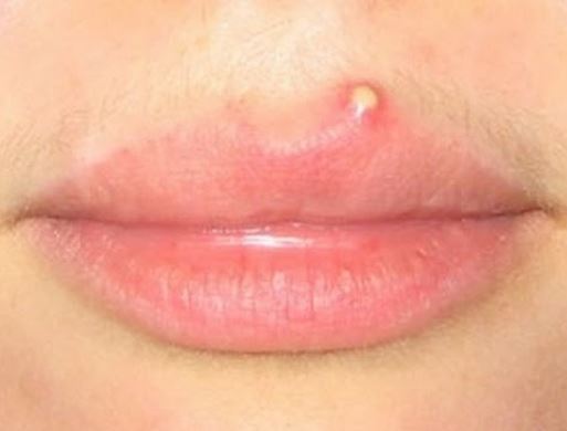 Can You Get a Pimple on Your Lip?