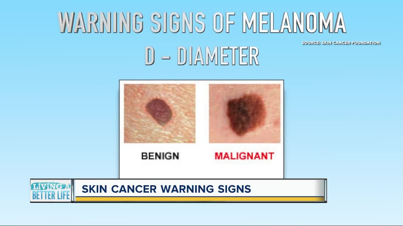 Can you spot skin cancer? Keep an eye out for these ...