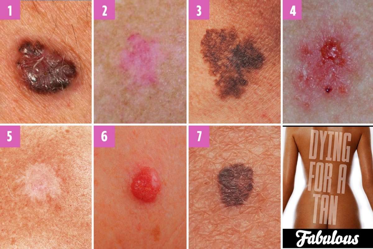 Can you spot which moles are deadly? The skin cancer signs you need to ...