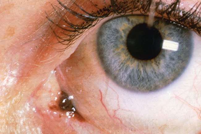 Cancer: Guide to Eye Cancers