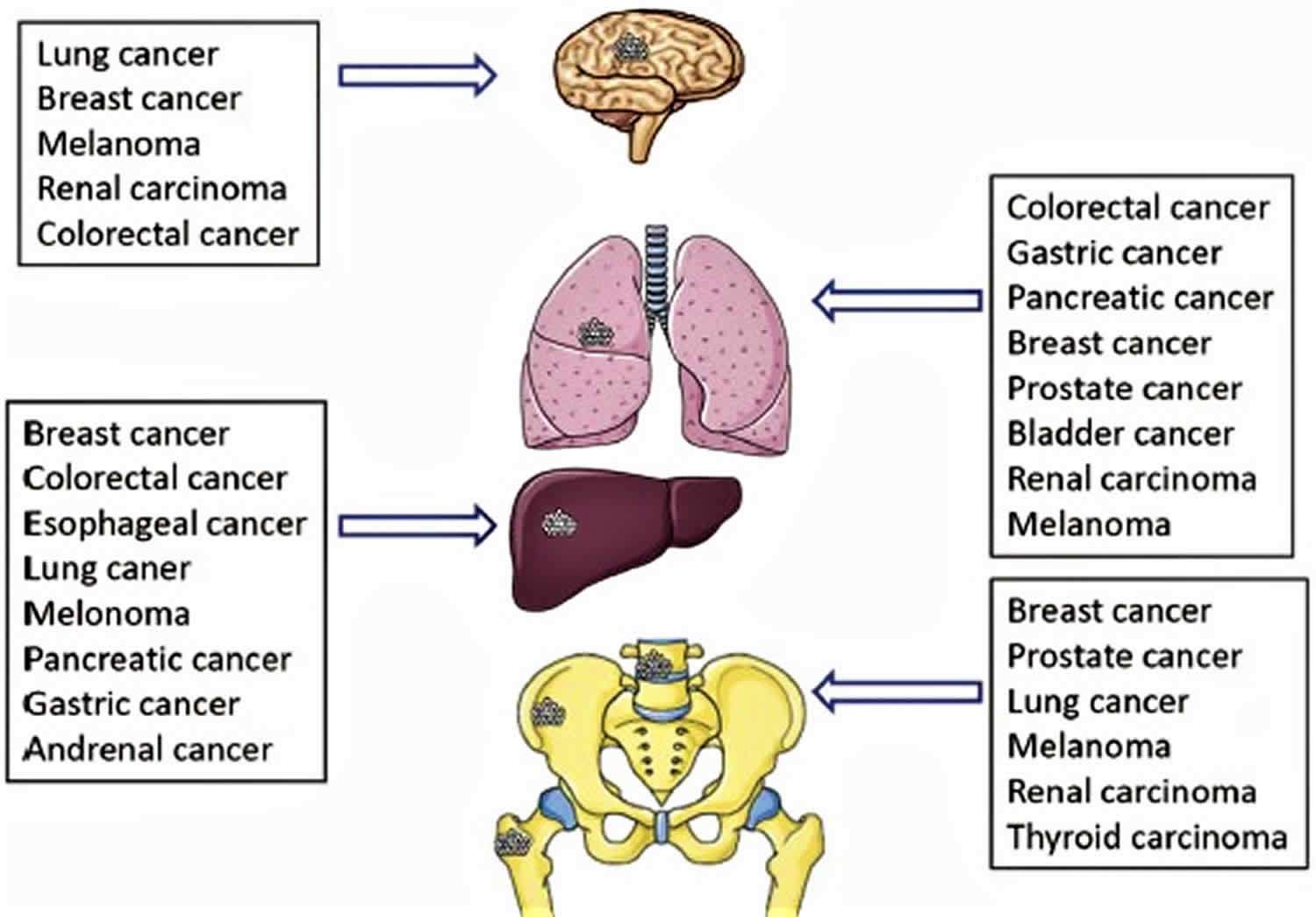 Cancer metastasis causes, symptoms and metastasis survival ...