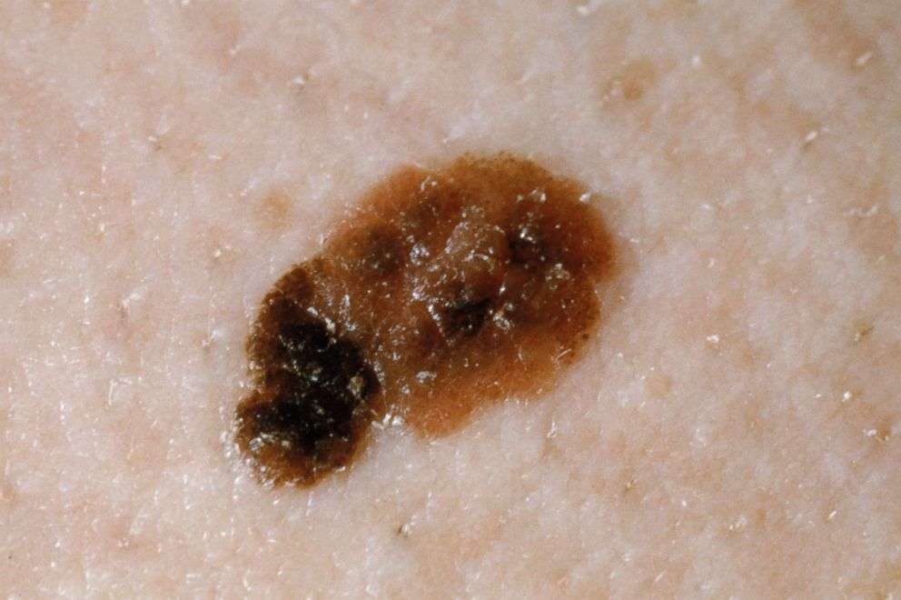 Cancerous melanomas can seem like they