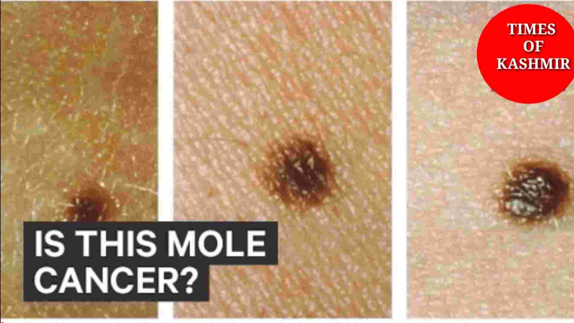 Cancerous moles: How to Get Rid of Moles on Skin