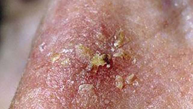 Cancro della pelle Rash: prurito e sintomi