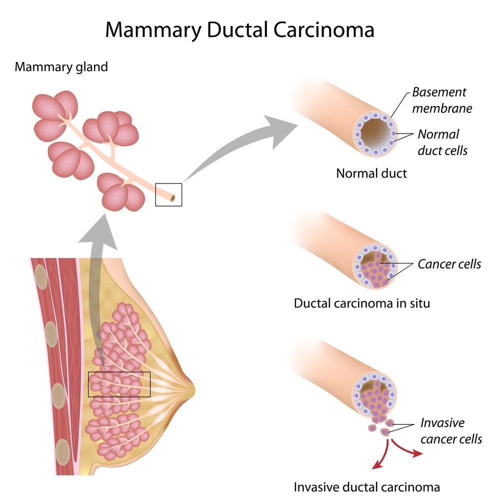 Cancer in situ молочной железы