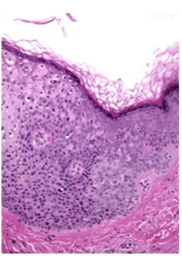 Carcinoma in situ, squamous cell. Causes, symptoms ...
