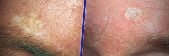 Causes and Treatment Options for White Spots on Skin