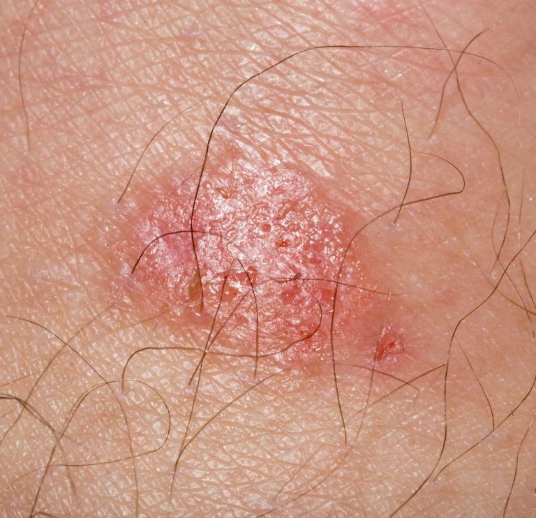 Causes of Rash on Inner Thigh and Treatment