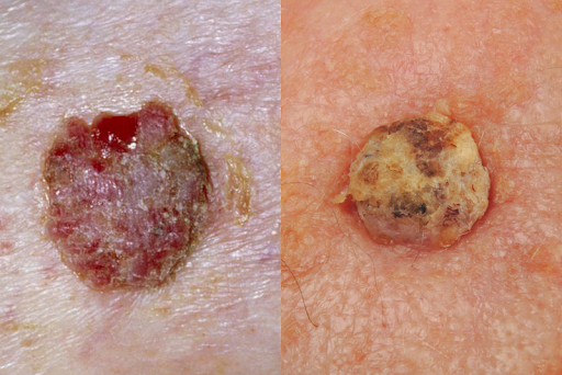 CC Treatment Observed Skin Pathological Uses and Mohs Surgery