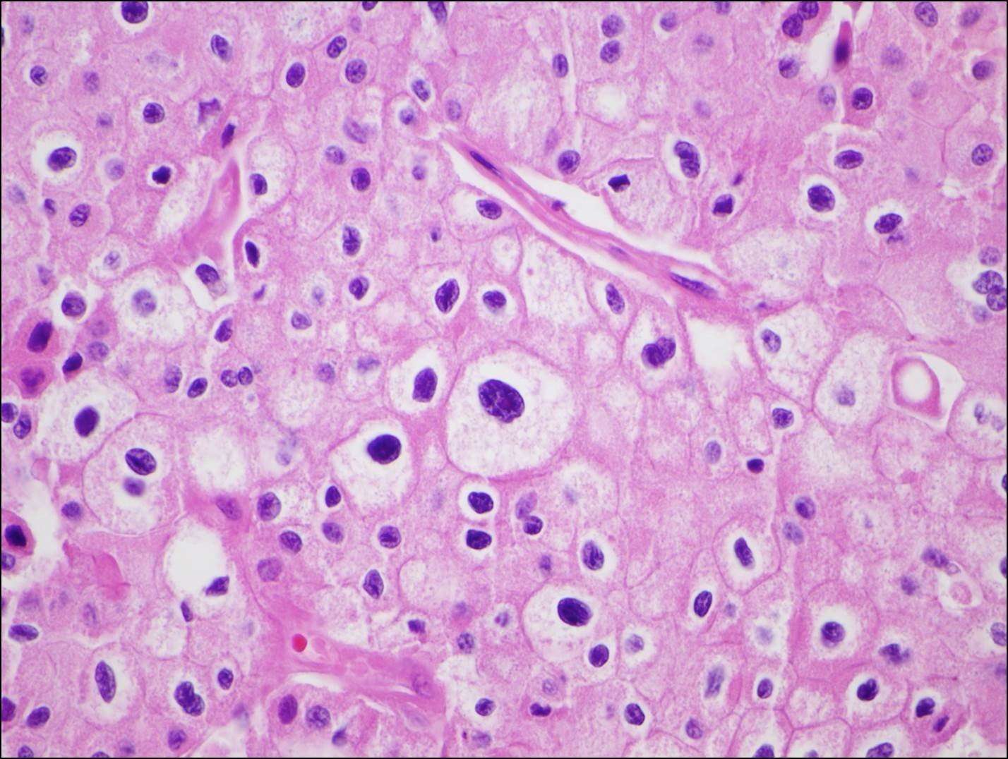 Chromophobe renal cell carcinoma