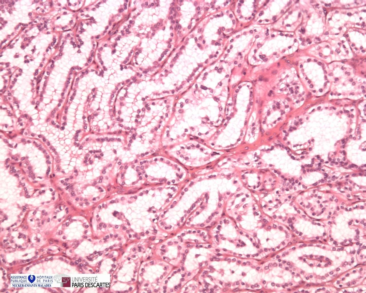 clear cell papillary renal cell carcinoma