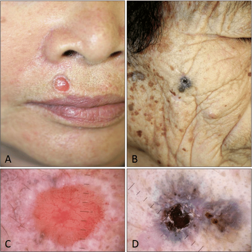 Clinical and dermoscopic photographs of squamous cell ...