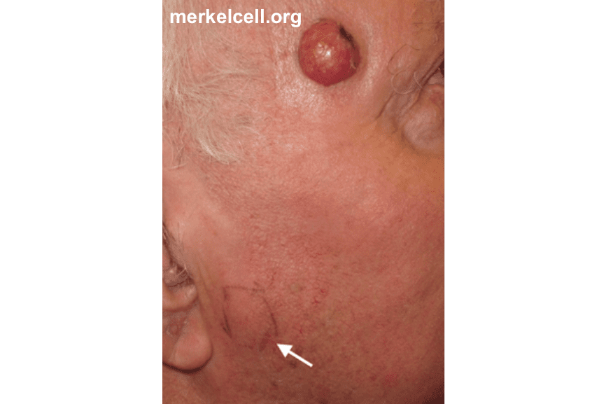 Clinical Photos of Merkel Cell Carcinoma