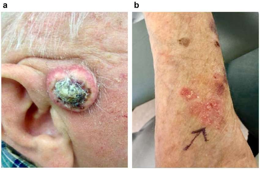 Clinical presentation of squamous cell carcinoma (SCC) and ...