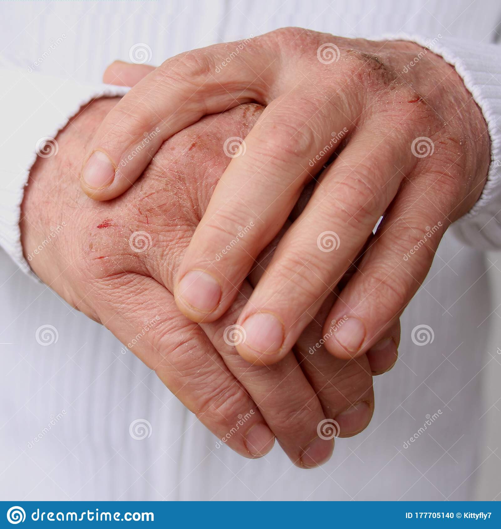 Close Up of Male Hands with Dry Skin Damage. Dermatology Concept Human ...