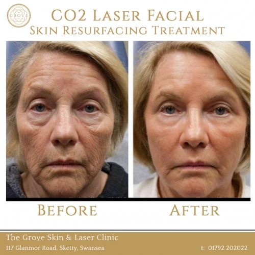 CO2 Laser Facial Skin Resurfacing Treatment Swansea Wales UK