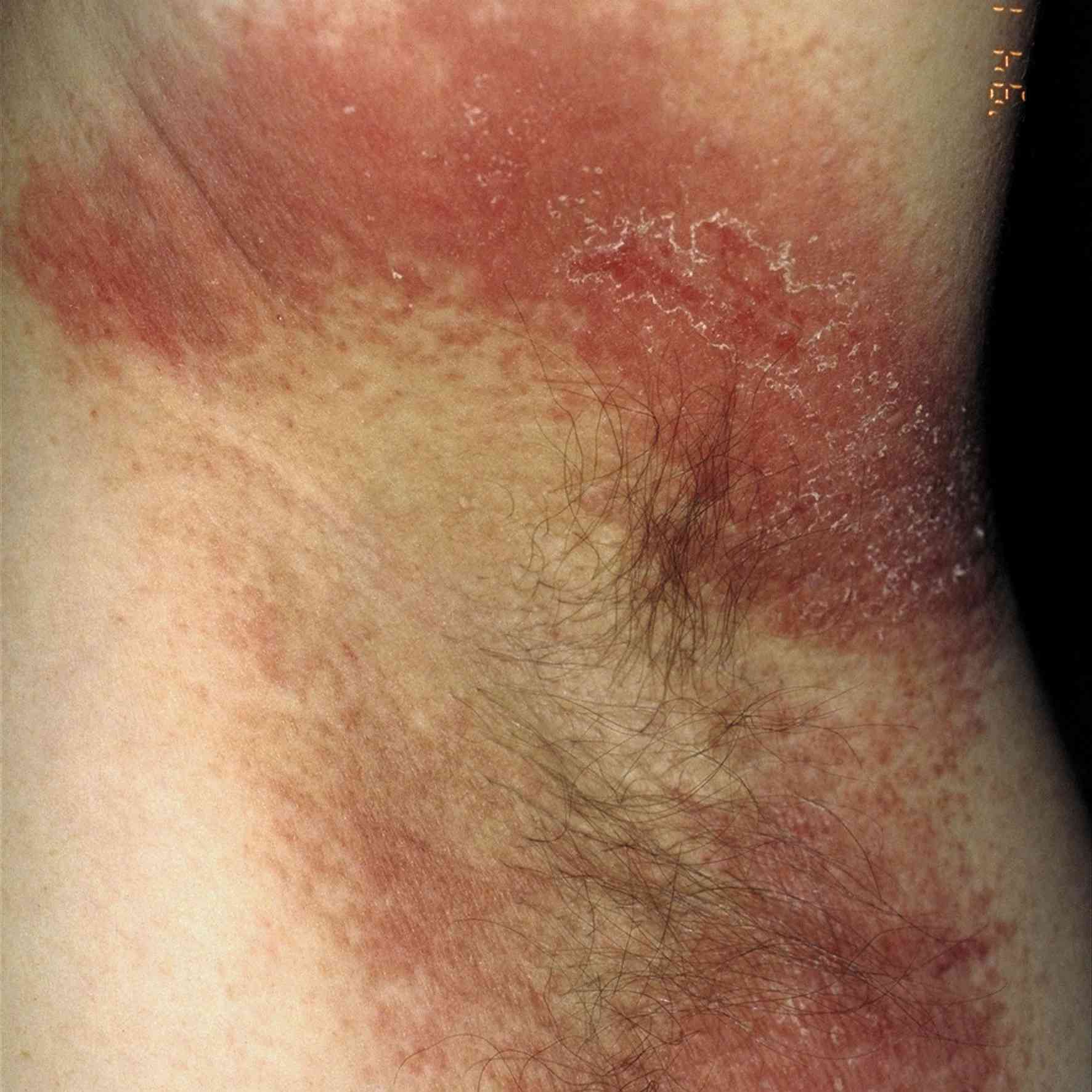 Common Rashes Found in the Armpits