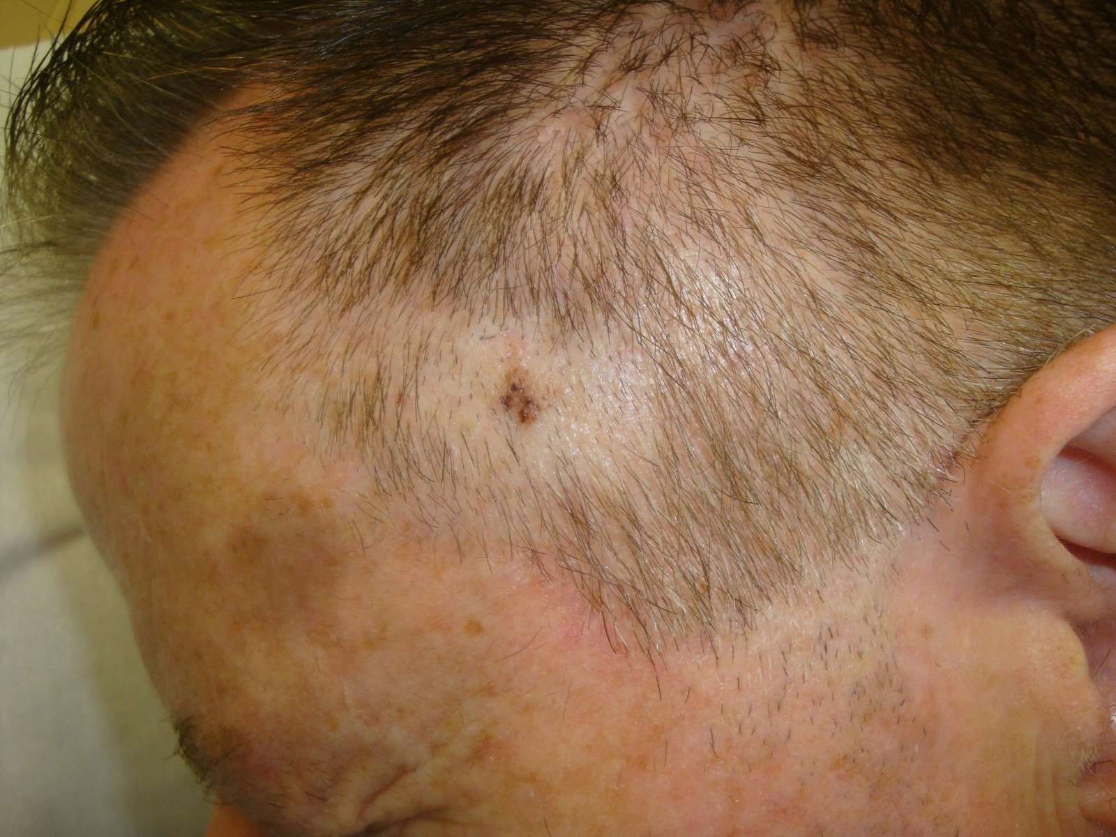 Consultations in Dermatology: Melanoma scalp