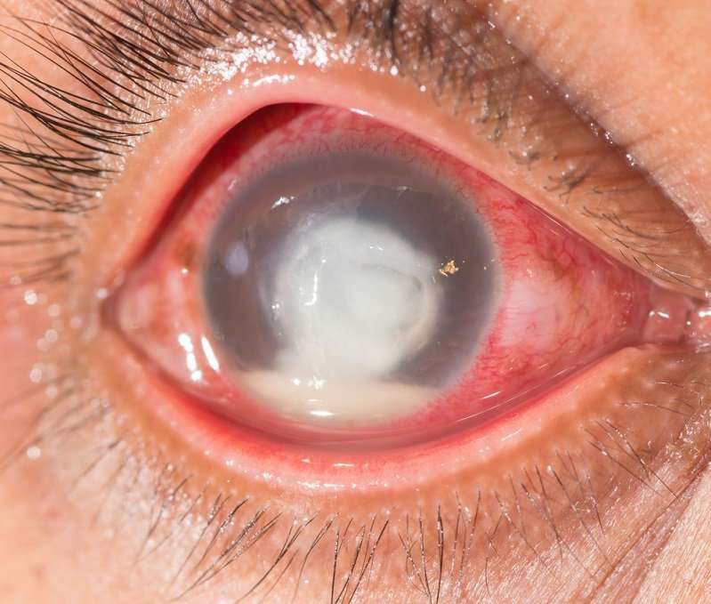 Corneal Ulcer 101: Causes, Symptoms and Treatment