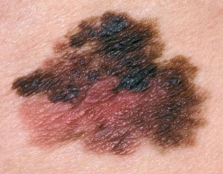 Could targeting this gene stop melanoma from spreading?