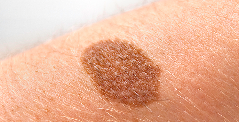 Crean nanovacuna para combatir el cáncer de piel más ...
