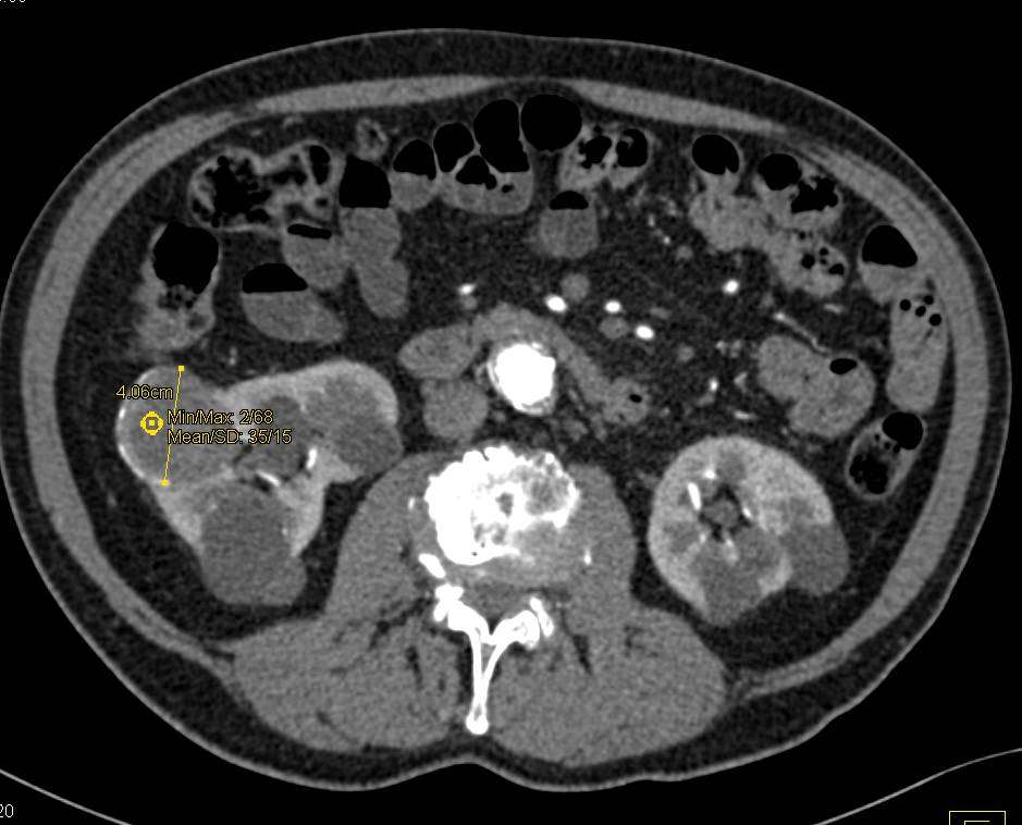 Cystic Renal Cell Carcinoma
