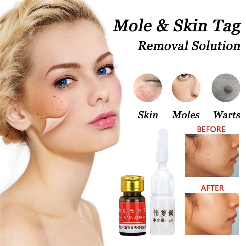 Dark Spot Removal Wart Tag Freckle Removal Oil Mole Skin Tag Removal ...