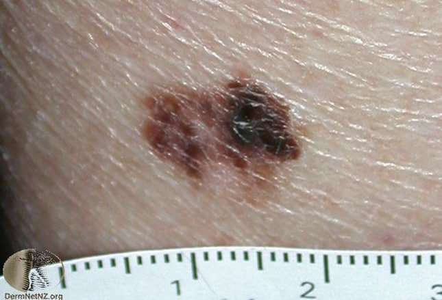 Deadly Skin Cancers You Need to Know