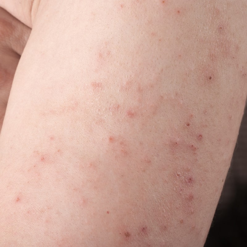 Dermatitis Herpetiformis: an itchy, burning, blistering rash!