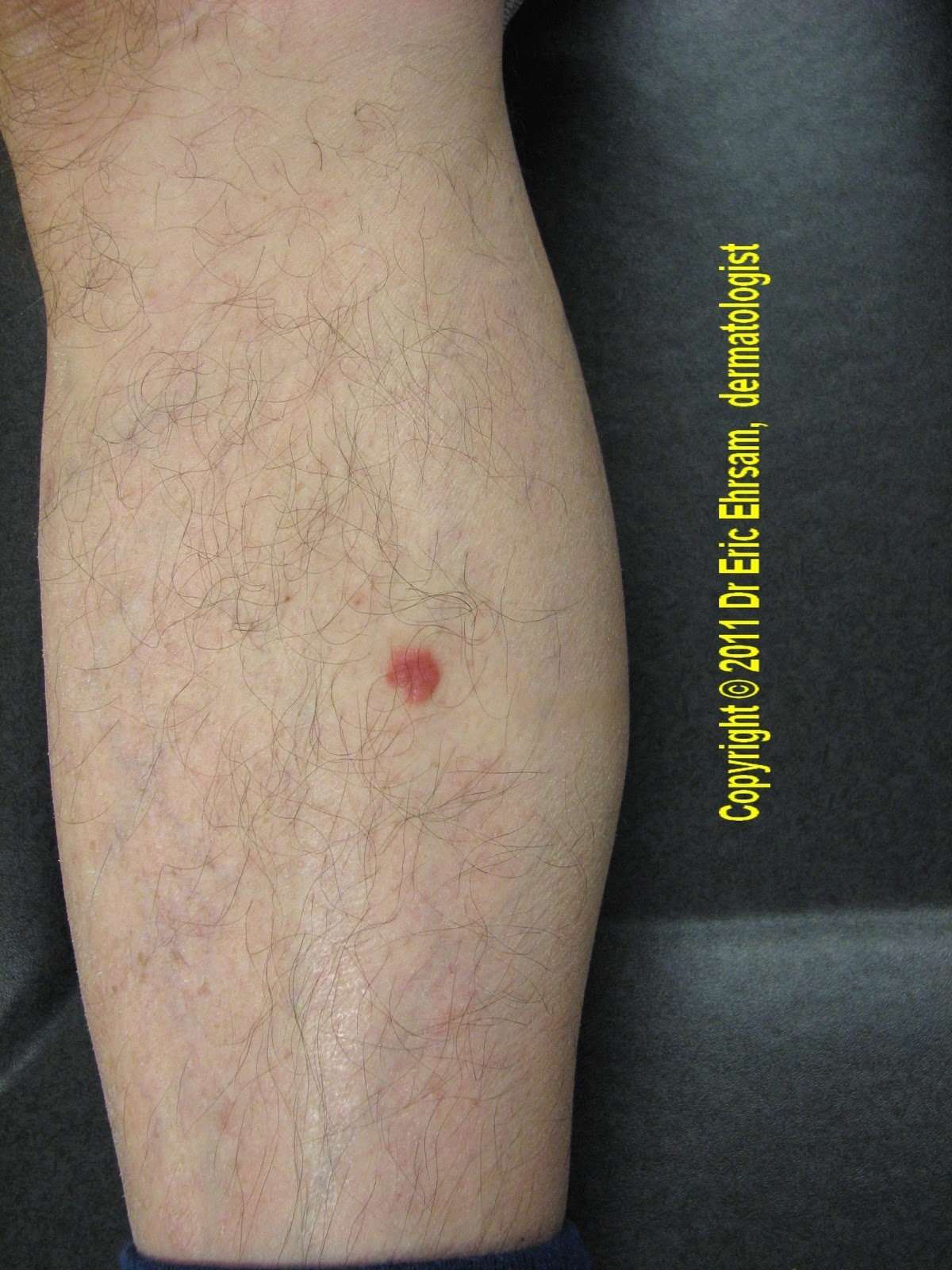 dermoscopy: A red tumor on a leg