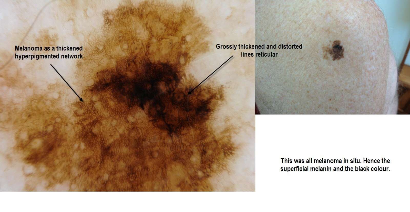 Dermoscopy Made Simple: Melanoma in situ mainly
