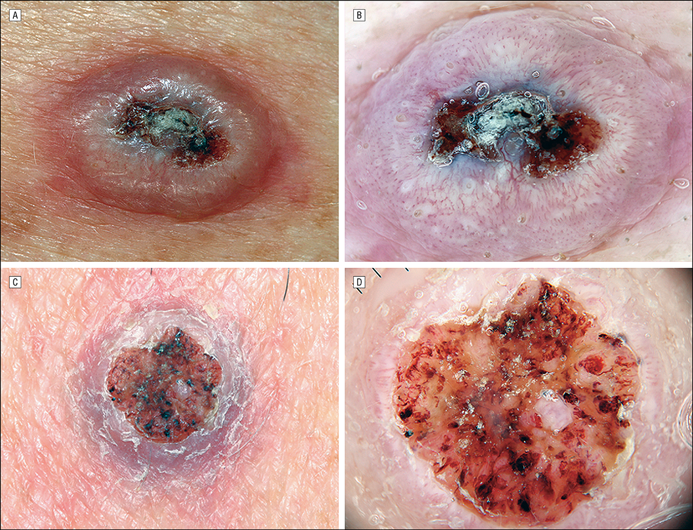 Dermoscopy of Squamous Cell Carcinoma and Keratoacanthoma ...