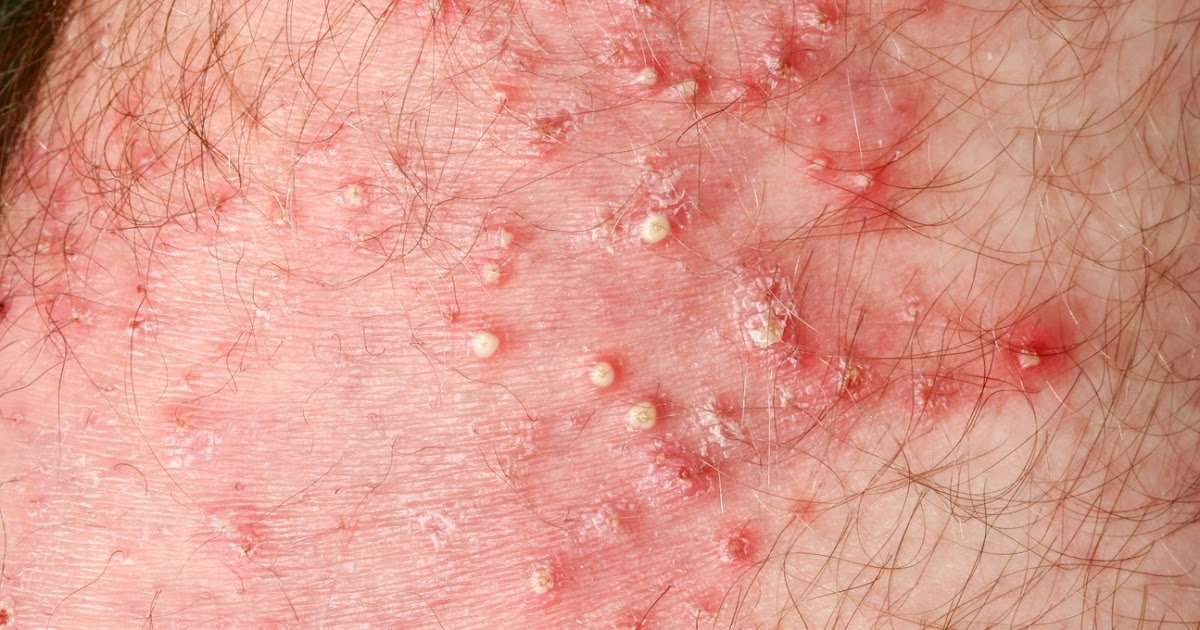 Diabetes And Itchy Skin Treatment