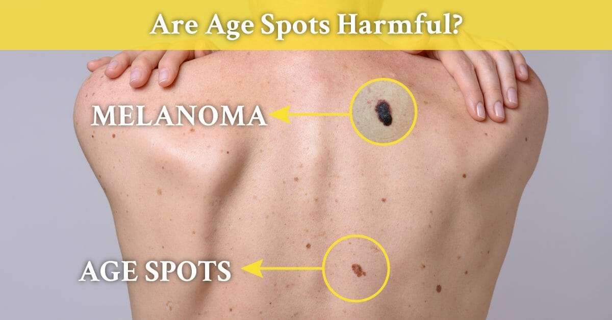 Discover the Best Natural Solutions for Age Spots.