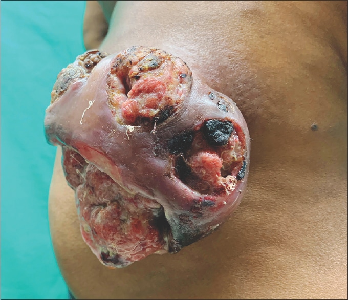 Disseminated cutaneous rhinosporidiosis: Revisited Sen S, Agrawal W ...