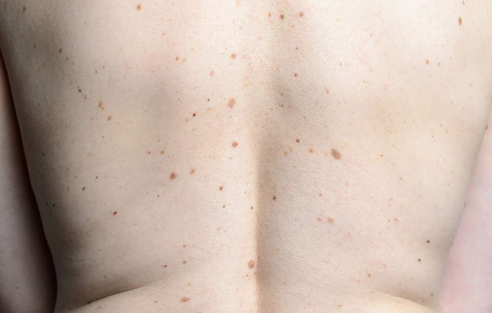Do Skin Cancer Spots Appear Suddenly