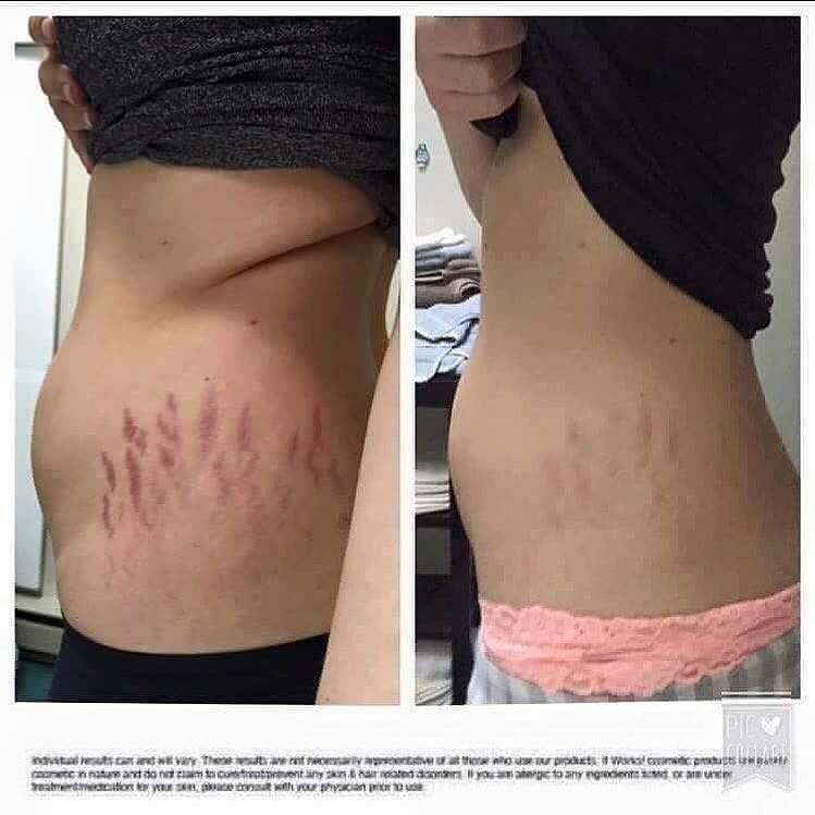 Do Stretch Marks Fade Away When You Lose Weight
