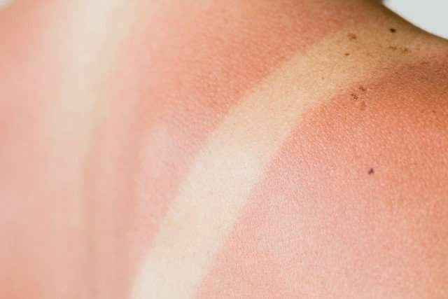 Do Sunburns Cause Skin Cancer?