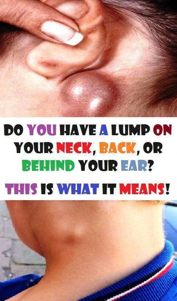 Do You Have A Lump On Your Neck, Back, Or Behind Your Ear ...