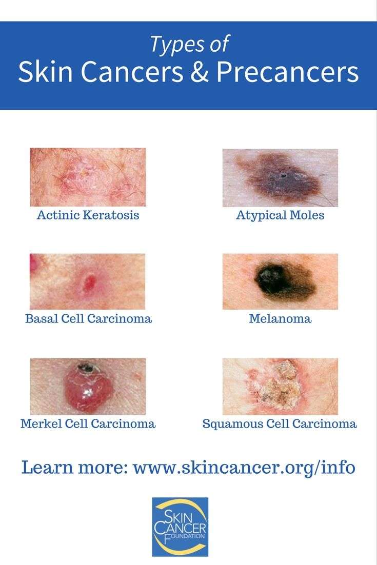Do you know all of the different types of skin cancers and ...
