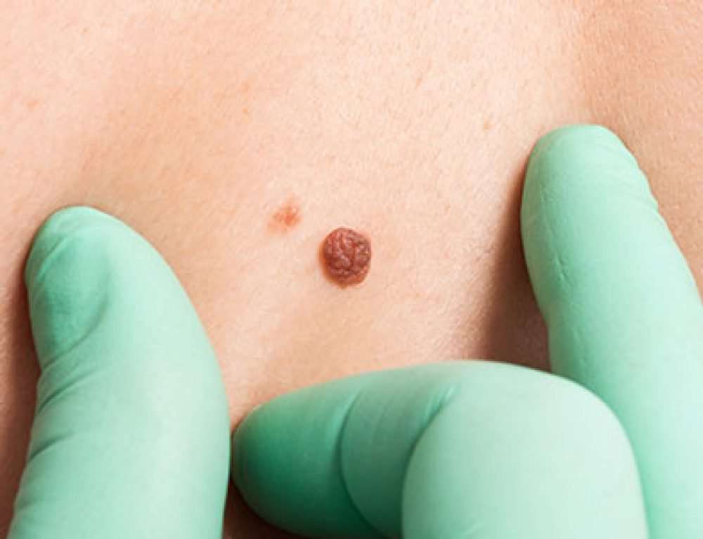 Do you know skin cancer when you see it?  Skin Repair