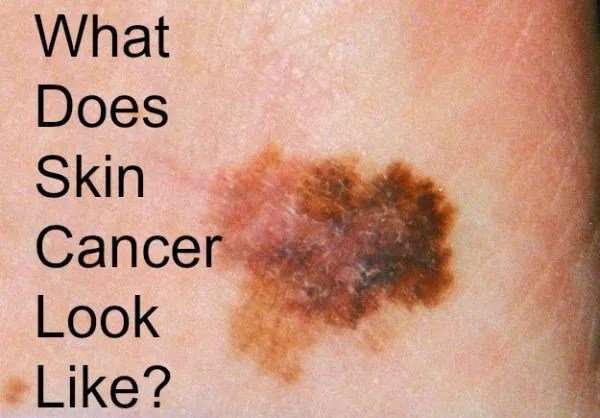 Do You Know What Skin Cancer Looks Like?  Bath and Body