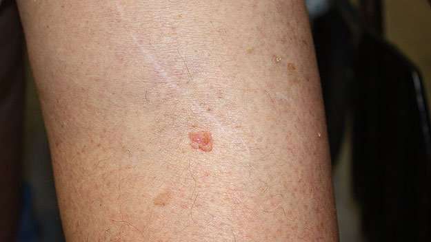Doctor Warns That Itchy Skin Spot May Suggest More ...