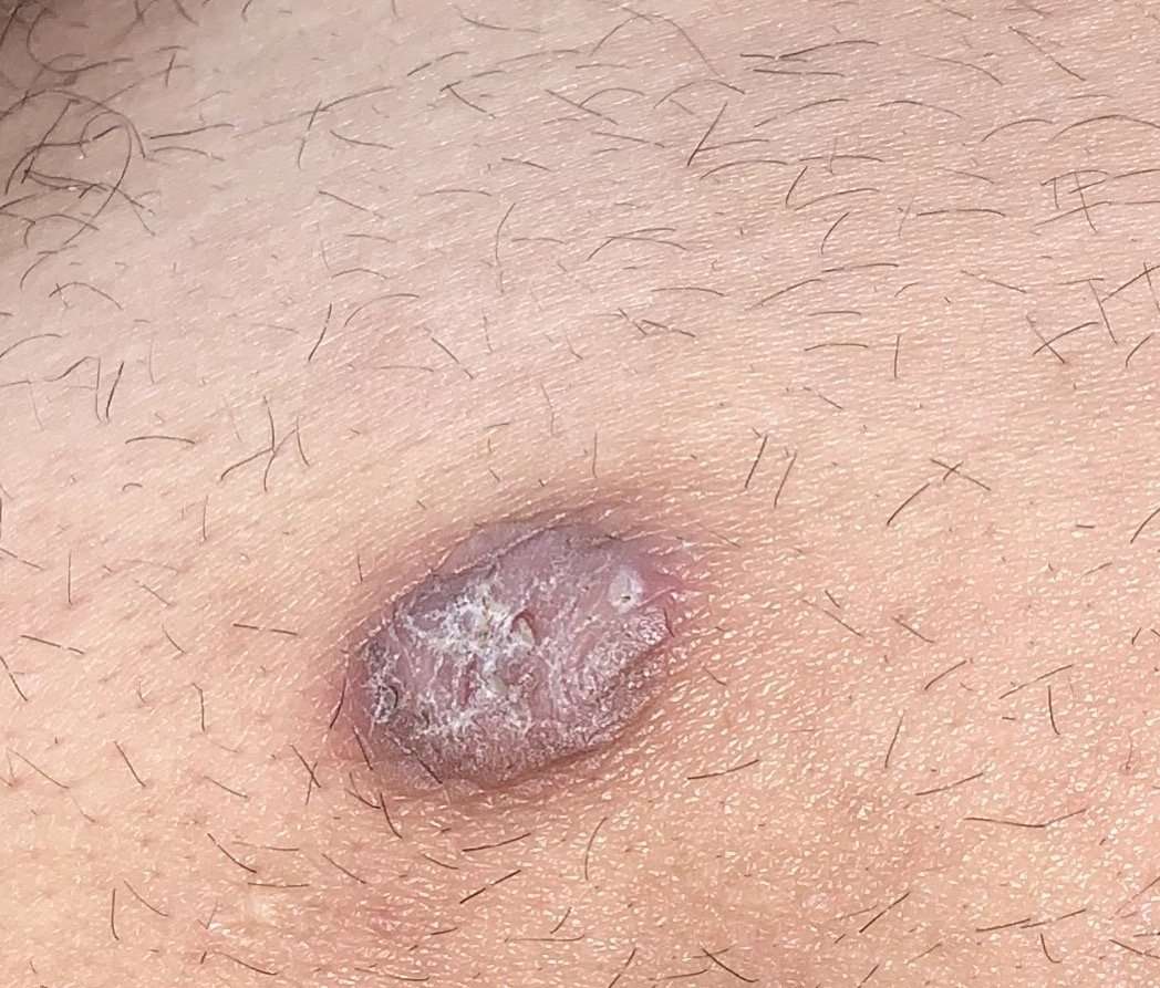 Does this look like skin cancer ??