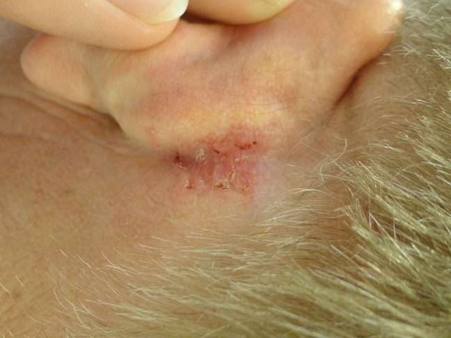 Dr. Joel Schlessinger » Blog Archive » Ear Skin Cancer