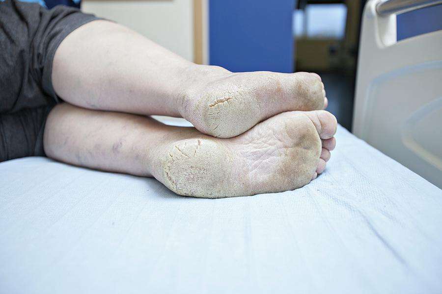 Dry And Cracked Feet In Diabetes Photograph by Lewis Houghton/science ...