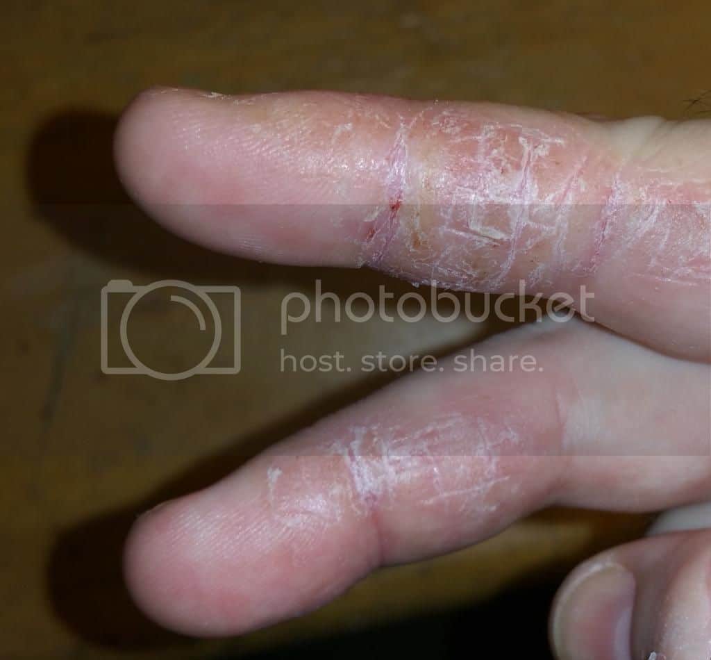 " Dry and Cracked Skin on Fingers. Several Years now and Fed Up!!" : Skin ...