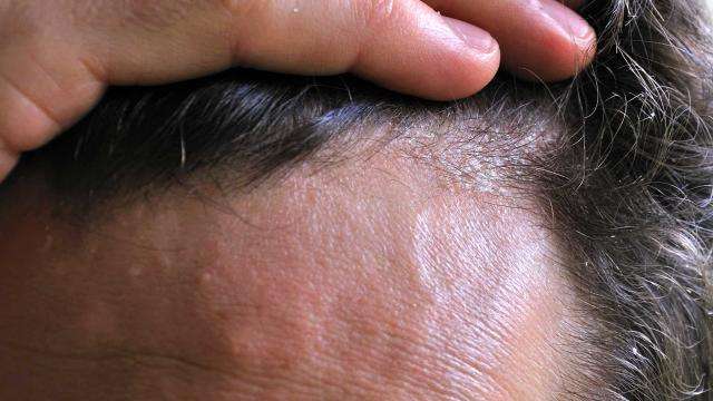Dry Scalp Diseases and Treatments