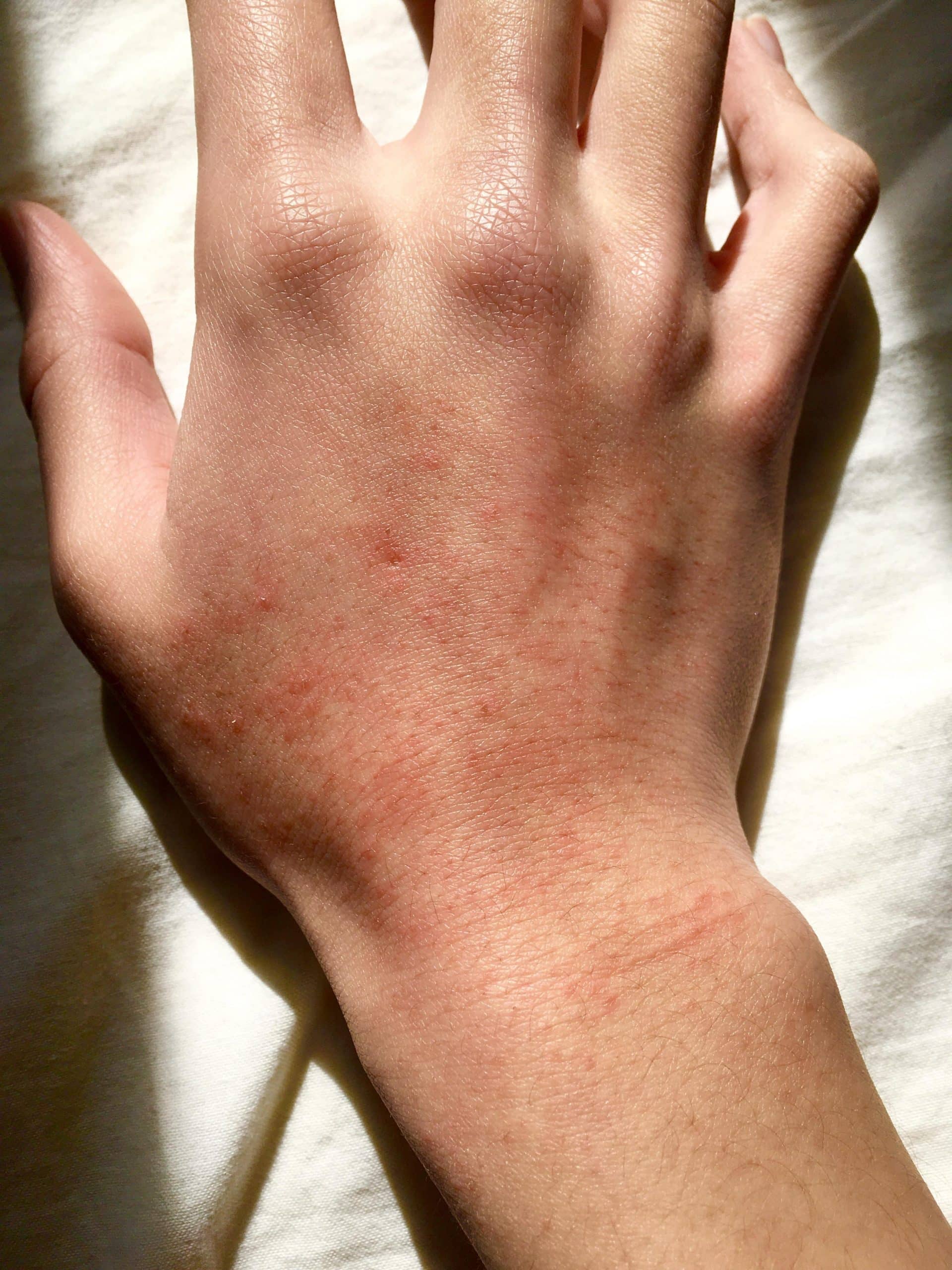 Dry skin on hand became painful rash? : Accutane